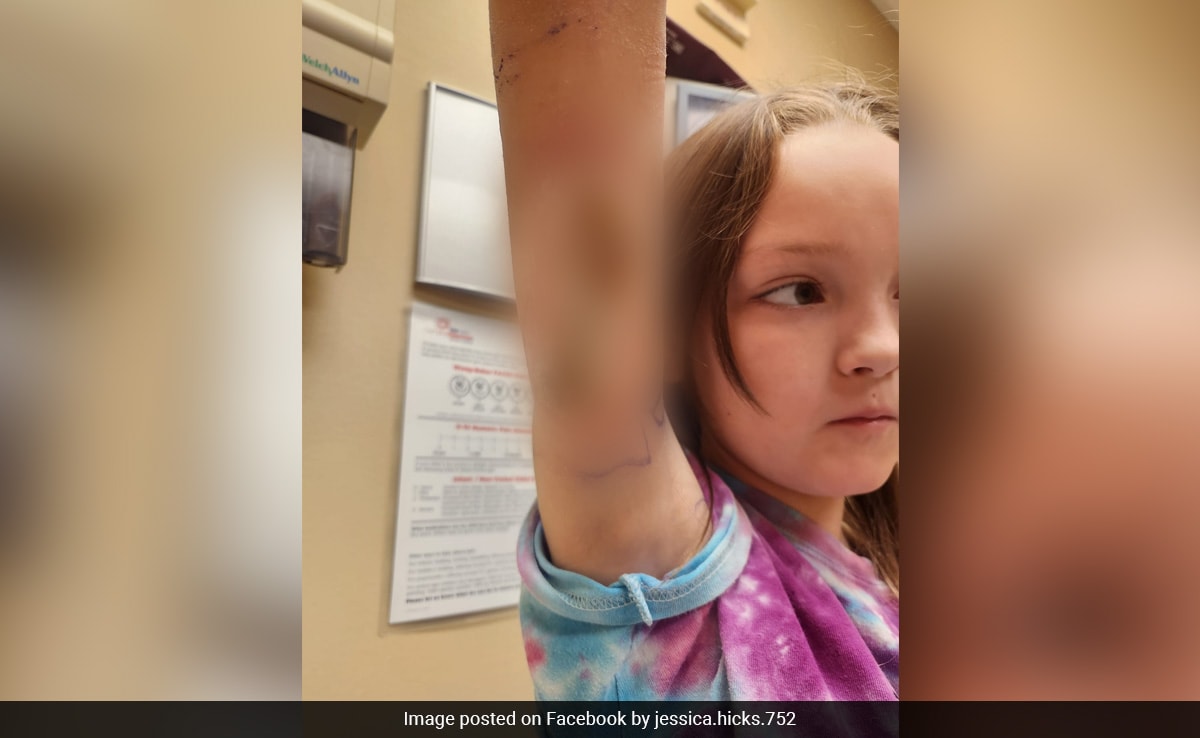 Girl, 9, Complains Of Pinch. Then Mother Discovers Spider Bite That Quickly Spread