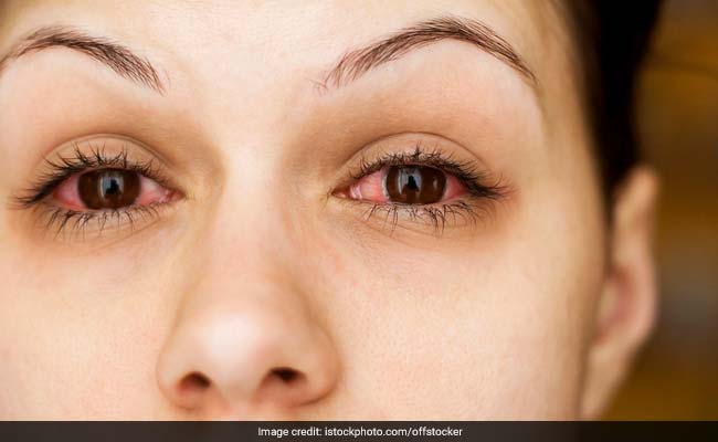 Pink Eye Epidemic Sweeping Parts of Pakistan, Infecting Lakhs Of People