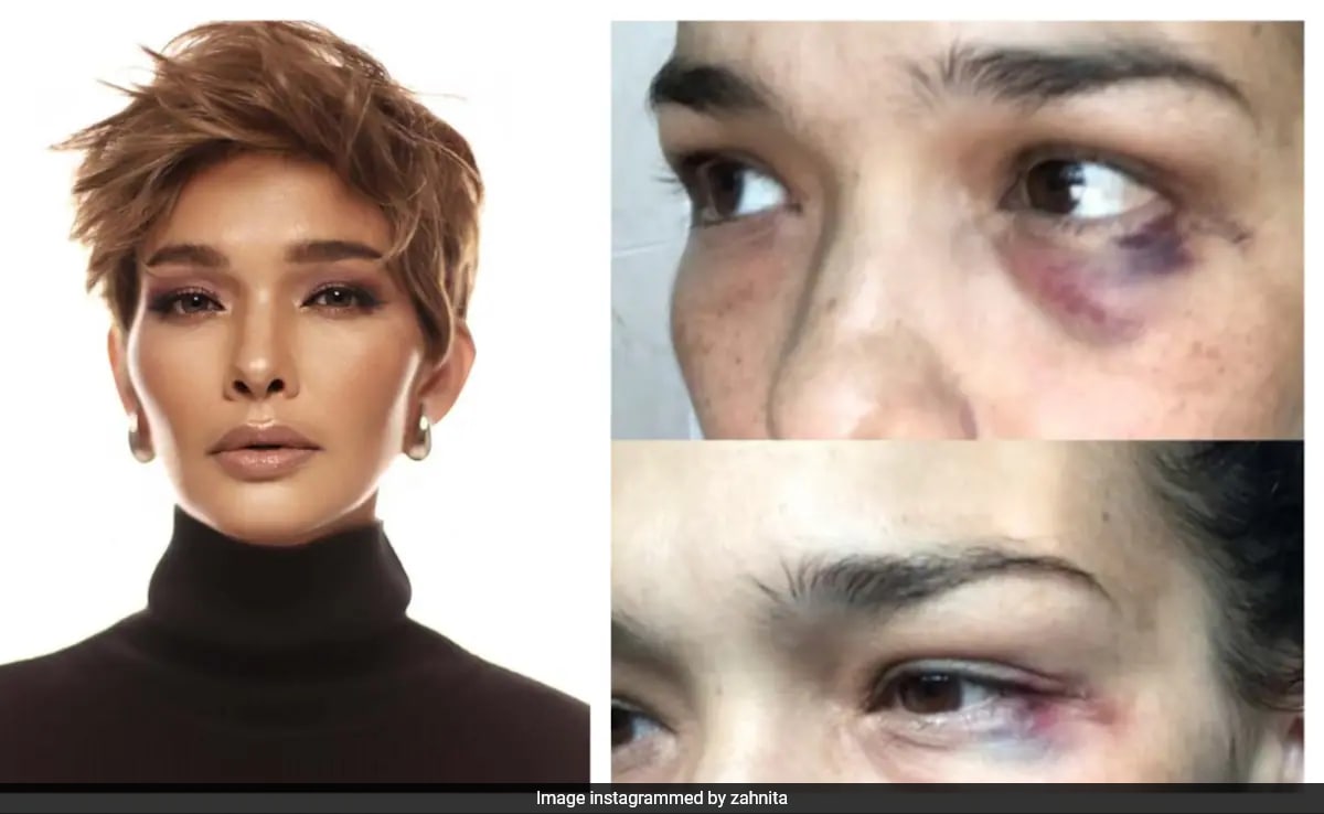 Malaysian Actor Alleges 2 Decades Of Domestic Abuse By Husband, Pics Show Bruises On Her Face