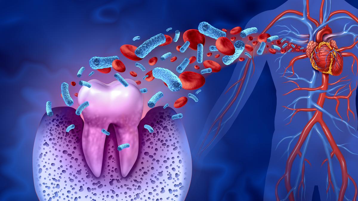 Could hidden dental bacteria help explain sudden and deadly heart attacks?