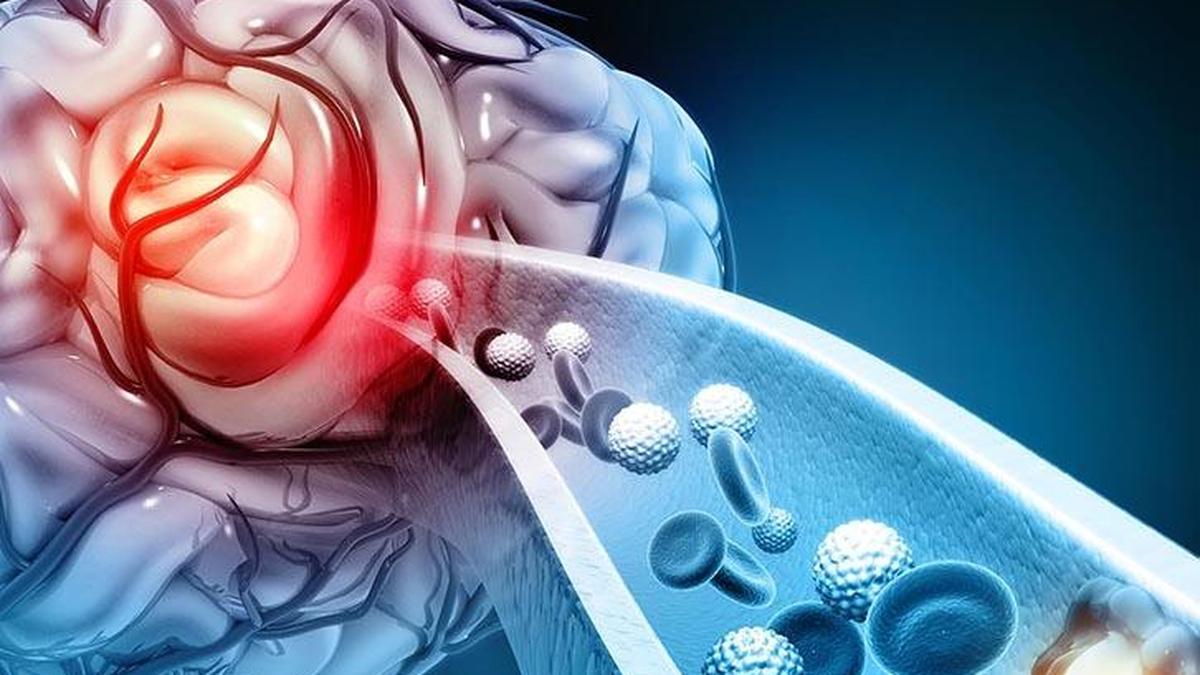 Indigenously built stroke device approved on domestic trial data, launch set for February 2026