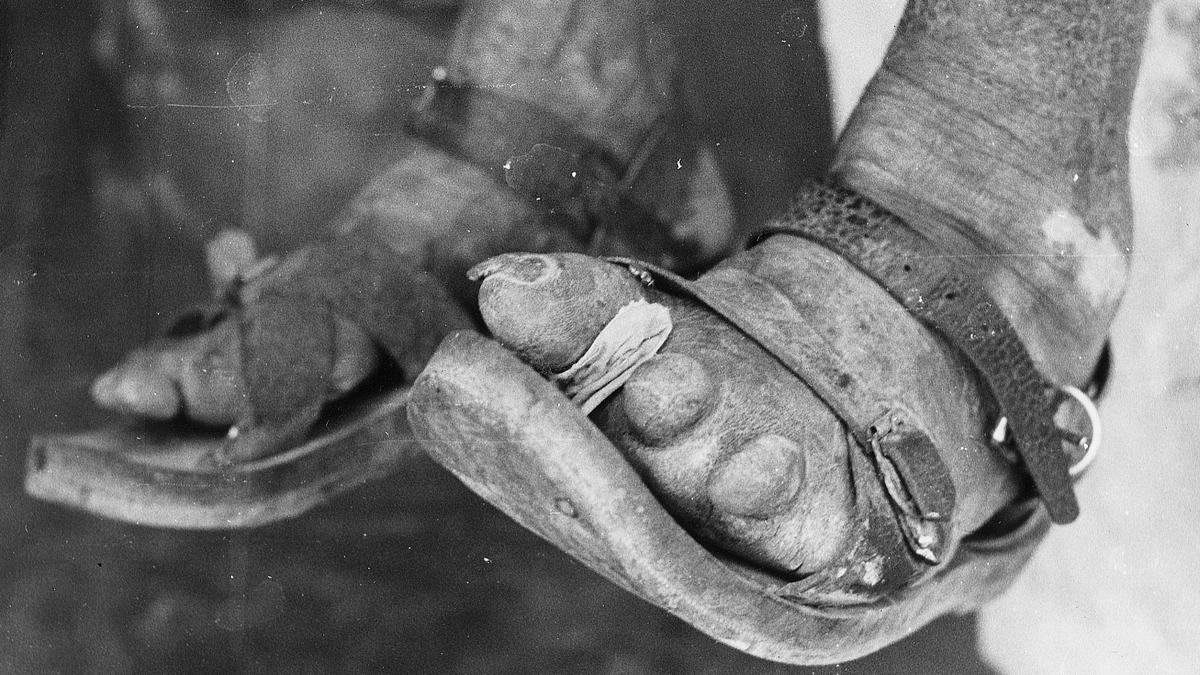 The story of dapsone: from dye to drug