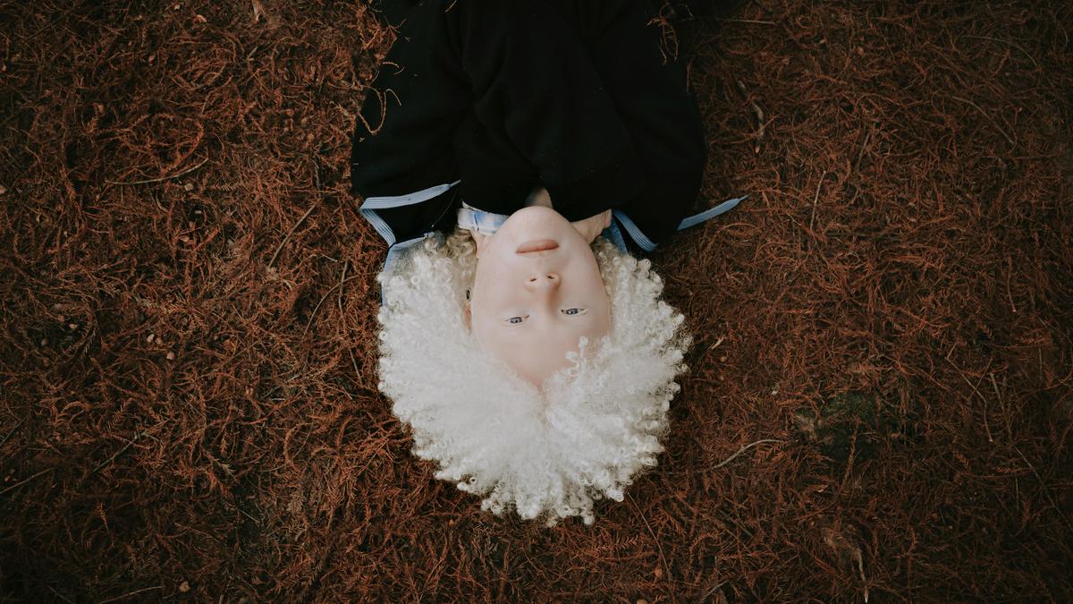 Understanding albinism – The Hindu