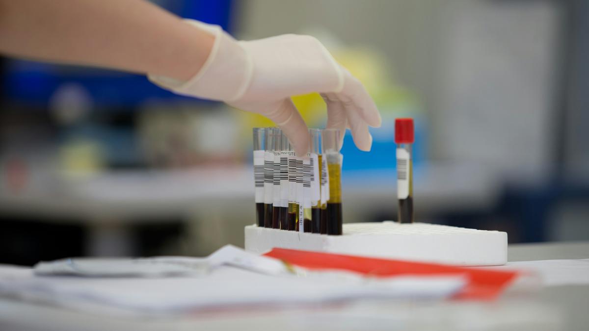 Scientists find a blood test that predicts lung cancer years early